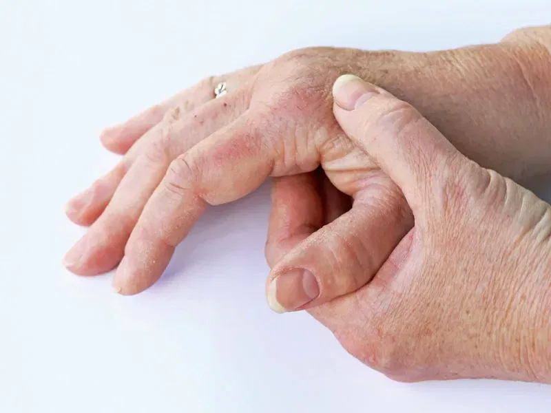 Schüssler-Salze und Arthrose